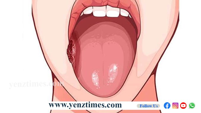 oralcancer